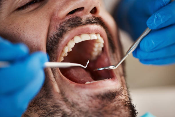 Best Emergency Root Canal Treatment in Bellevue, WA